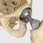 Arthritis and Hip Replacement in Ranchi: What You Need to Know