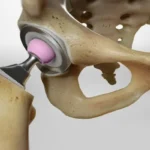 What’s the Typical Age for Hip Replacement Surgery?