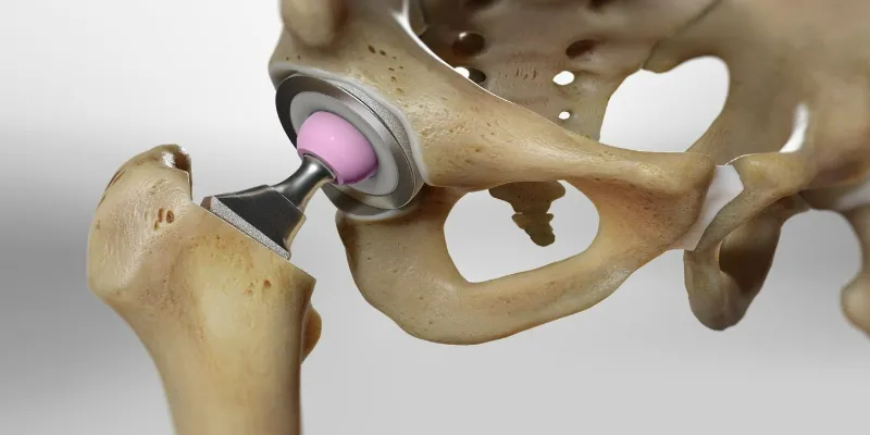 What’s the Typical Age for Hip Replacement Surgery?