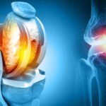 10 Questions to Ask Your Orthopedic Surgeon in Ranchi Before Knee Replacement