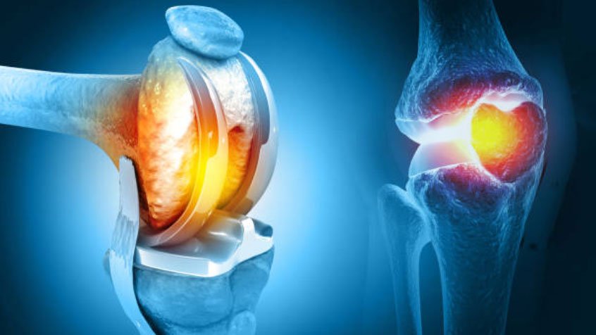 10 Questions to Ask Your Orthopedic Surgeon in Ranchi Before Knee Replacement