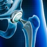 All You Need to Know About Total Hip Replacement in Ranchi
