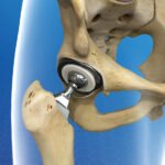 What Should I Expect During Total Hip Replacement Surgery in Ranchi?