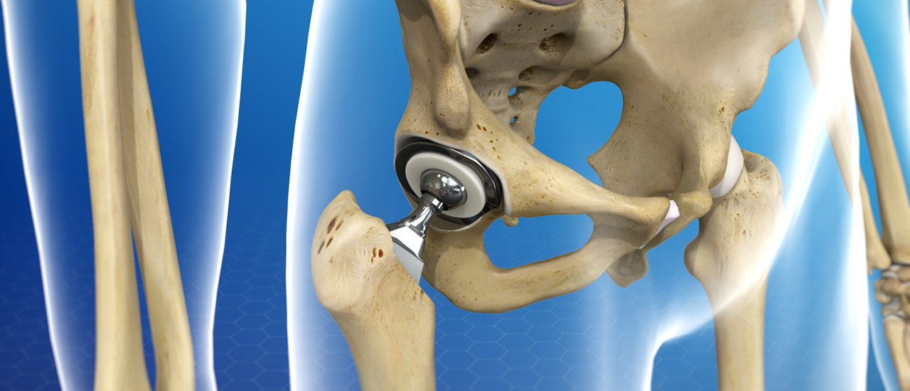 What Should I Expect During Total Hip Replacement Surgery in Ranchi?