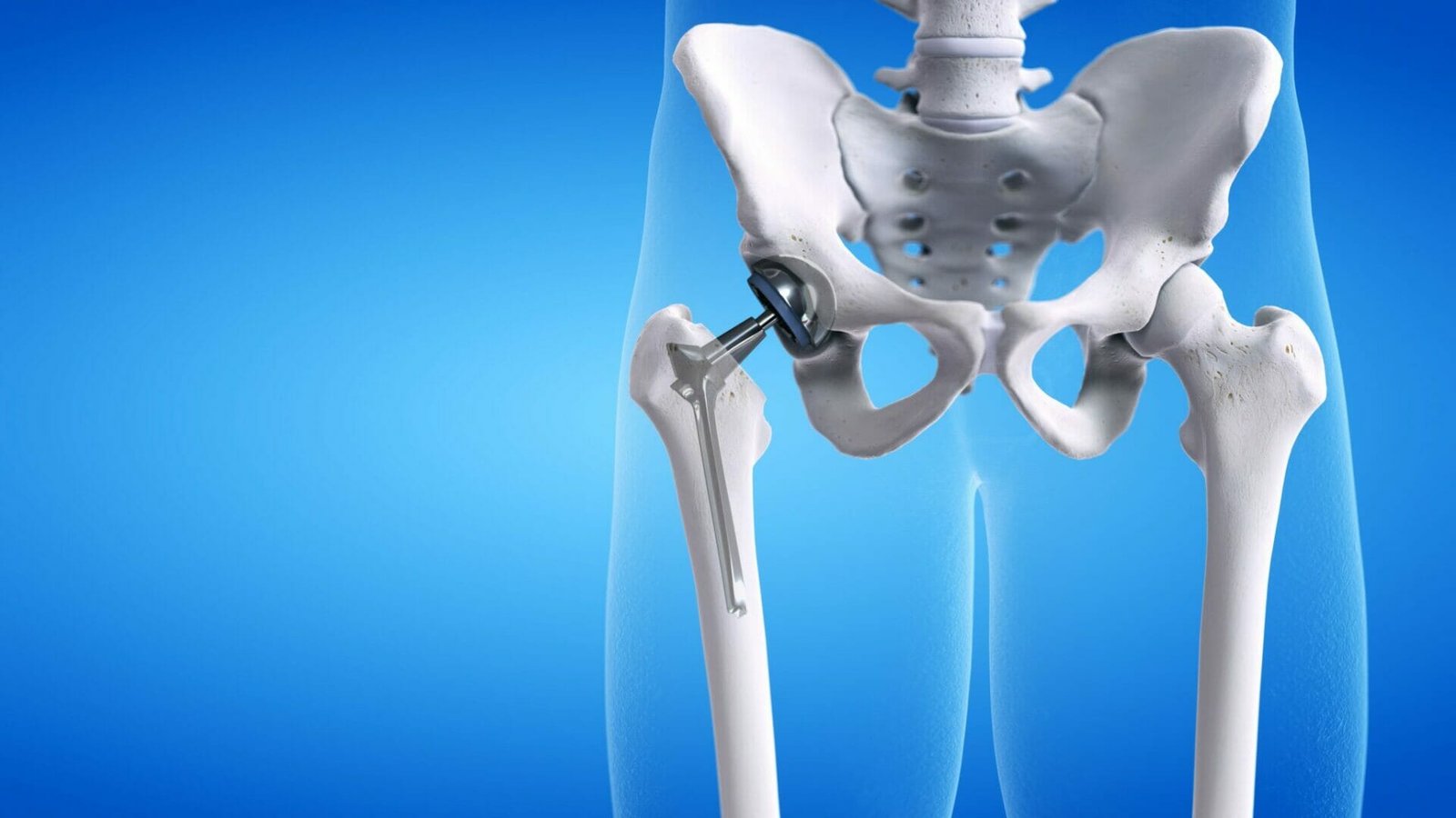 What Causes Buttock Pain After Hip Replacement?