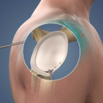 Best Bankart Repair Treatment in Ranchi by Dr. Ujjwal Sinha – Improve shoulder stability with Expert Care