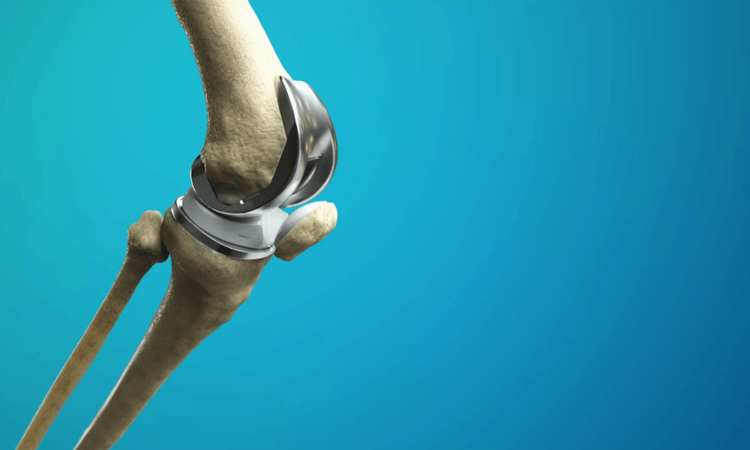 Experience Pain-Free Treatment Joint Replacement Surgeon in Ranchi