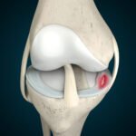 Meniscal Injury Treatment in Ranchi: Expert Care for a Painful Knee