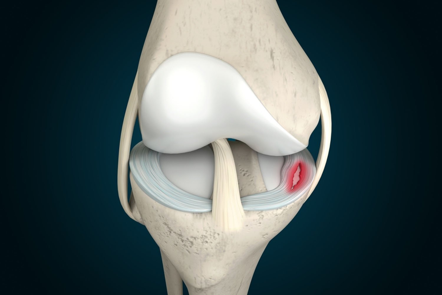 Meniscal Injury Treatment in Ranchi: Expert Care for a Painful Knee